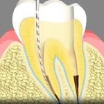 Root Canals Estes Park