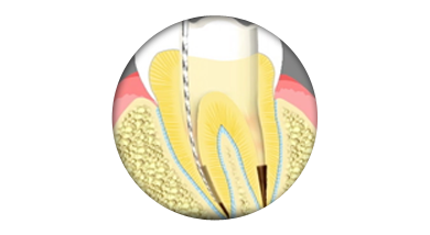 Root Canals Estes Park