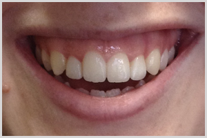 After Veneers